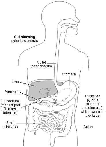 Pyloric Stenosis